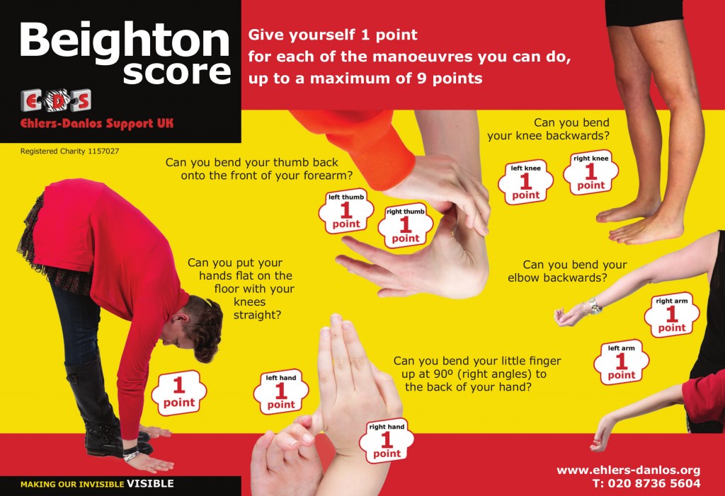 beighton score ehlers danlos syndrome