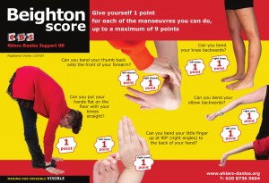 beighton score ehlers danlos syndrome